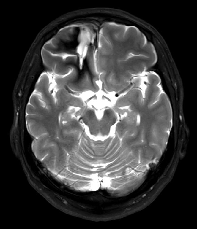 2023년 9월 수술 이후의 뇌 사진. 혈관종이 말끔히 사라졌다.