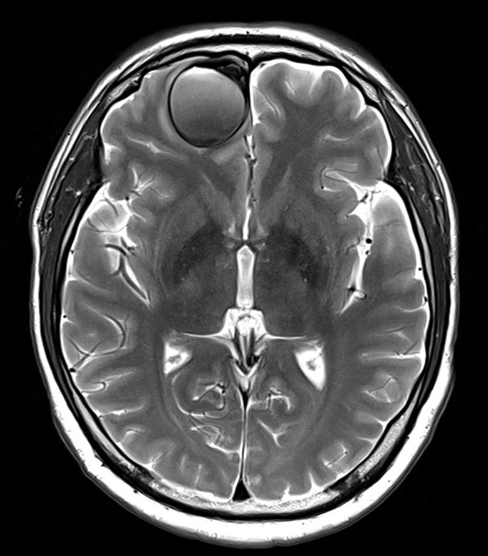 2021년 2월 당시 이태현 씨의 뇌 MRI 사진. 왼쪽 이마 부분에 혈관종이 보인다.