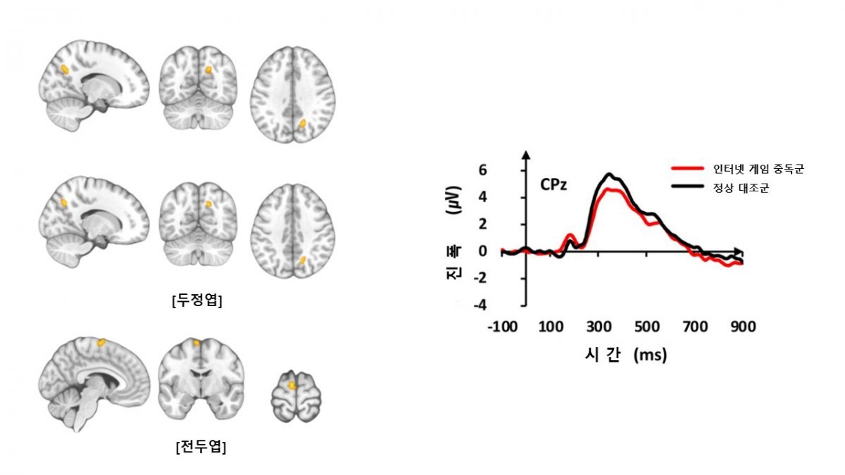 기능적 MRI 검사 결과 인터넷 게임 중독군은 정상 대조군보다 두정엽과 전두엽 부위에서 뇌 활성이
 증가했다(왼쪽 사진). 청각 자극에 대한 뇌파 신호의 진폭은 인터넷 게임 중독군이 정상 대조군보다 감소했다(오른쪽 그래프). 
삼성서울병원 제공