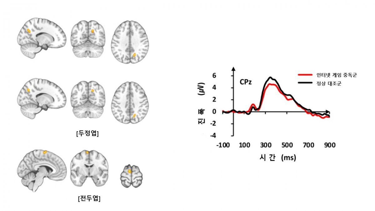 기능적 MRI 검사 결과 인터넷 게임 중독군은 정상 대조군보다 두정엽과 전두엽 부위에서 뇌 활성이  증가했다(왼쪽 사진). 청각 자극에 대한 뇌파 신호의 진폭은 인터넷 게임 중독군이 정상 대조군보다 감소했다(오른쪽 그래프).  삼성서울병원 제공