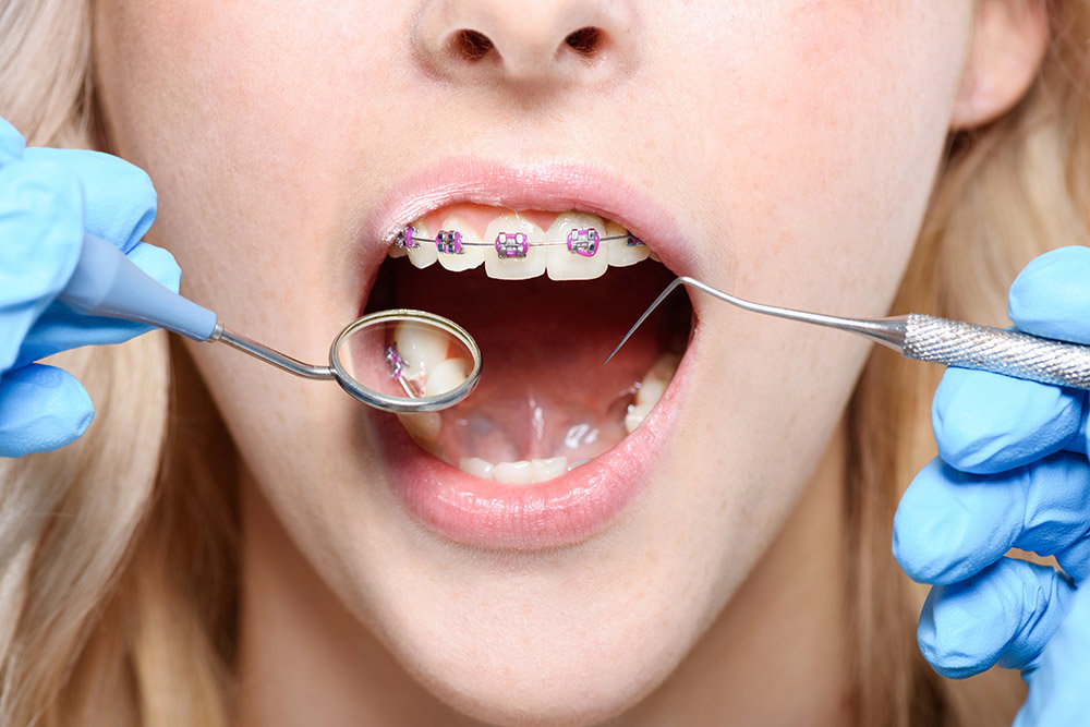 치아교정에는 철사 교정 장치를 많이 사용한다 / 출처=엔바토엘리먼트