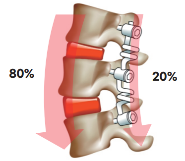 반강성고정술의 경우 척추의 전방부와 후방부의 하중 분배 비율이 약 8:2에 근접한다.