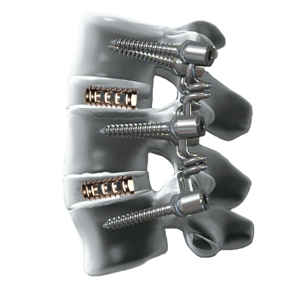 척추 앞쪽은 나사선 형태의 원통 케이지를, 척추 뒤쪽은 니티놀 스프링 로드에 기반한 바이오플렉스를 삽입한 반강성고정술 모식도.
