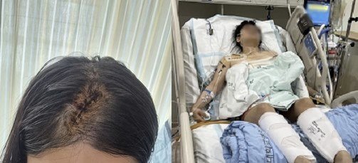 전 남자친구의 스토킹에 시달리다가 흉기에 머리를 맞고 가슴을 찔린 여성. (온라인 커뮤니티 갈무리)
