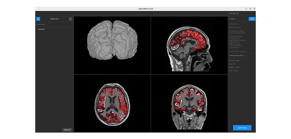 뉴로엑스티는 MRI 분석을 통한 알츠하이머 치매 진단 및 치료 솔루션을 개발했다 / 출처=뉴로엑스티