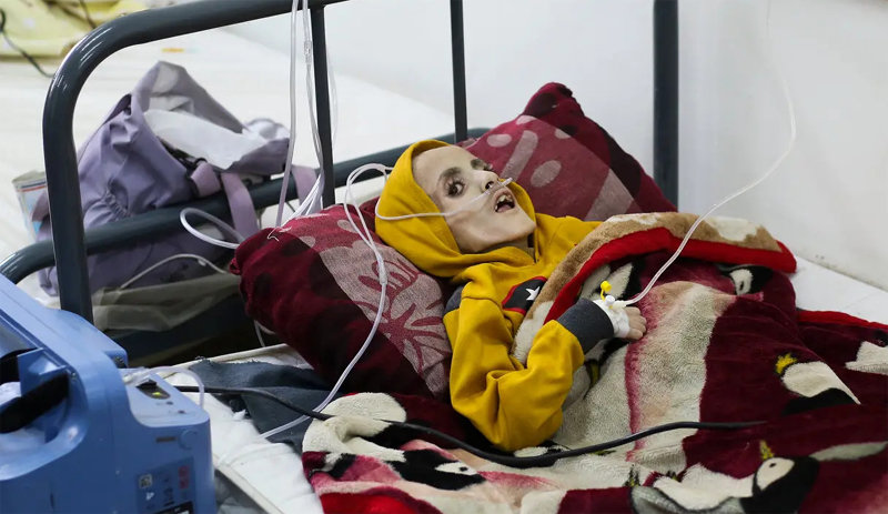 영양실조 등에 시달리다 4일 숨진 팔레스타인 가자지구의 뇌성마비 소년 야잔 카파르네가 사망 전날인 3일 병원에 누워 있는 모습. 사진 출처 소셜미디어 ‘X’(옛 트위터)