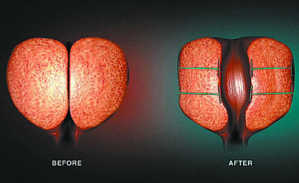 전립선비대증으로 비대해진 전립선(왼쪽)과 유로리프트를 통해 비대해진 전립선을 묶은 모습.