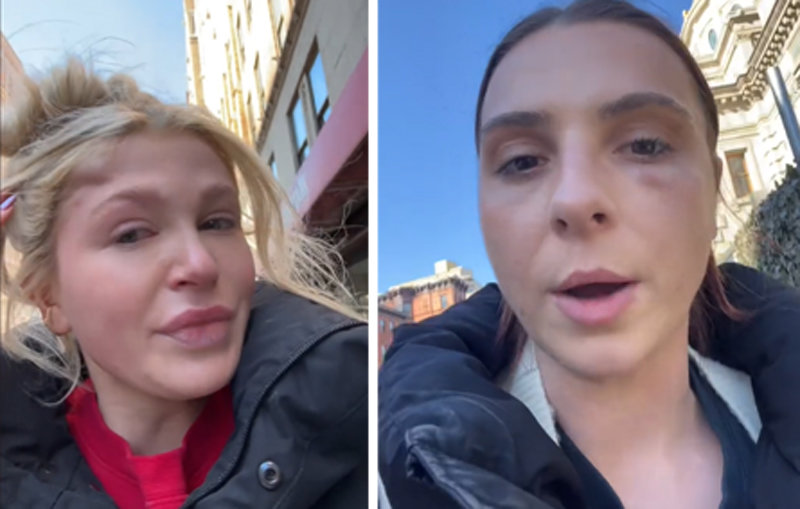 미국 뉴욕에 사는 핼리 케이트 맥구킨 씨(왼쪽)와 미케일라 토니나토 씨(오른쪽)가 25일 맨해튼에서 길을 걷다가 이유 없이 얼굴을 맞았다며 틱톡에 피해 경험을 공개했다. 사진 출처 틱톡