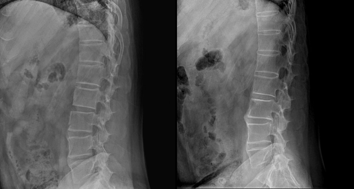 강직성 척추염을 앓는 B 씨의 척추 X레이 사진. 2018년(왼쪽 사진)에는 뼈마디가 붙어 있지 않지만 지난해 사진(오른쪽 사진)에서는 대부분의 뼈마디가 붙어 버렸다. 서울아산병원 제공