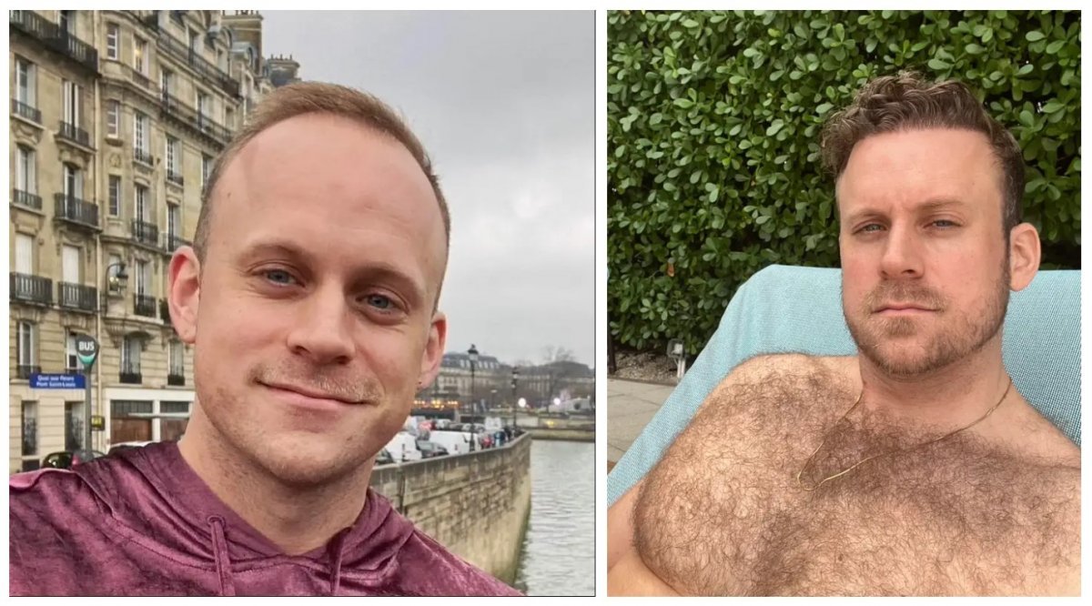 A comparison of Reporter McNaughton's close friend, Bennett, one month before receiving a hair transplant in Turkiye and 11 months after the procedure.  (Business Insider)