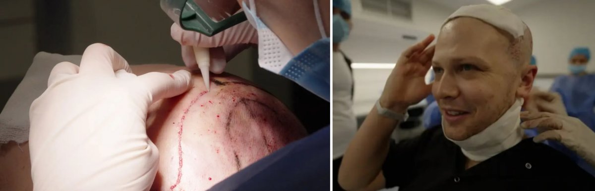 Medical staff are planting healthy hair on Reporter McNaughton's scalp.  (Left photo) On the right is Reporter McNaughton smiling after the procedure.  Business Insider