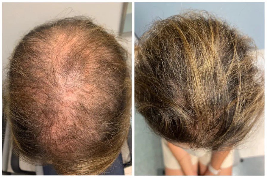 A patient in his 40s who visited the Johns Hopkins University School of Medicine overcame hair loss after taking oral minoxidil.  Johns Hopkins University School of Medicine