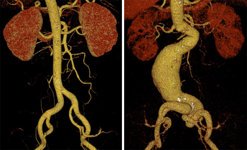 복부대동맥을 컴퓨터 단층촬영(CT)한 모습. 정상적인 혈관 굵기는 2∼2.5cm 정도(왼쪽 사진)인데, 이것이 부풀어 오르면서 복부대동맥류가 된다. 권준교 서울아산병원 혈관외과 교수 제공