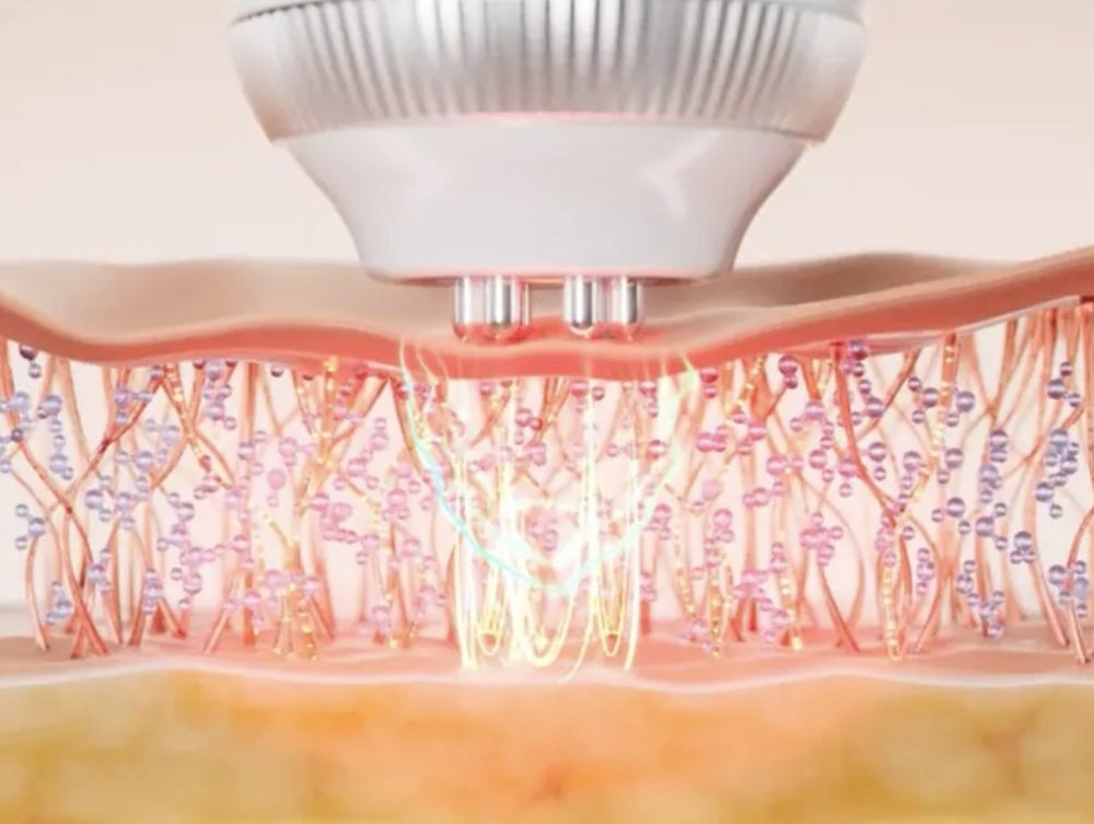 전극이 피부에 고주파와 미세 전류를 전달해 콜라겐 생성을 촉진한다. 사진은 이해를 돕기 위해 연출한 이미지 / 출처=메디큐브]