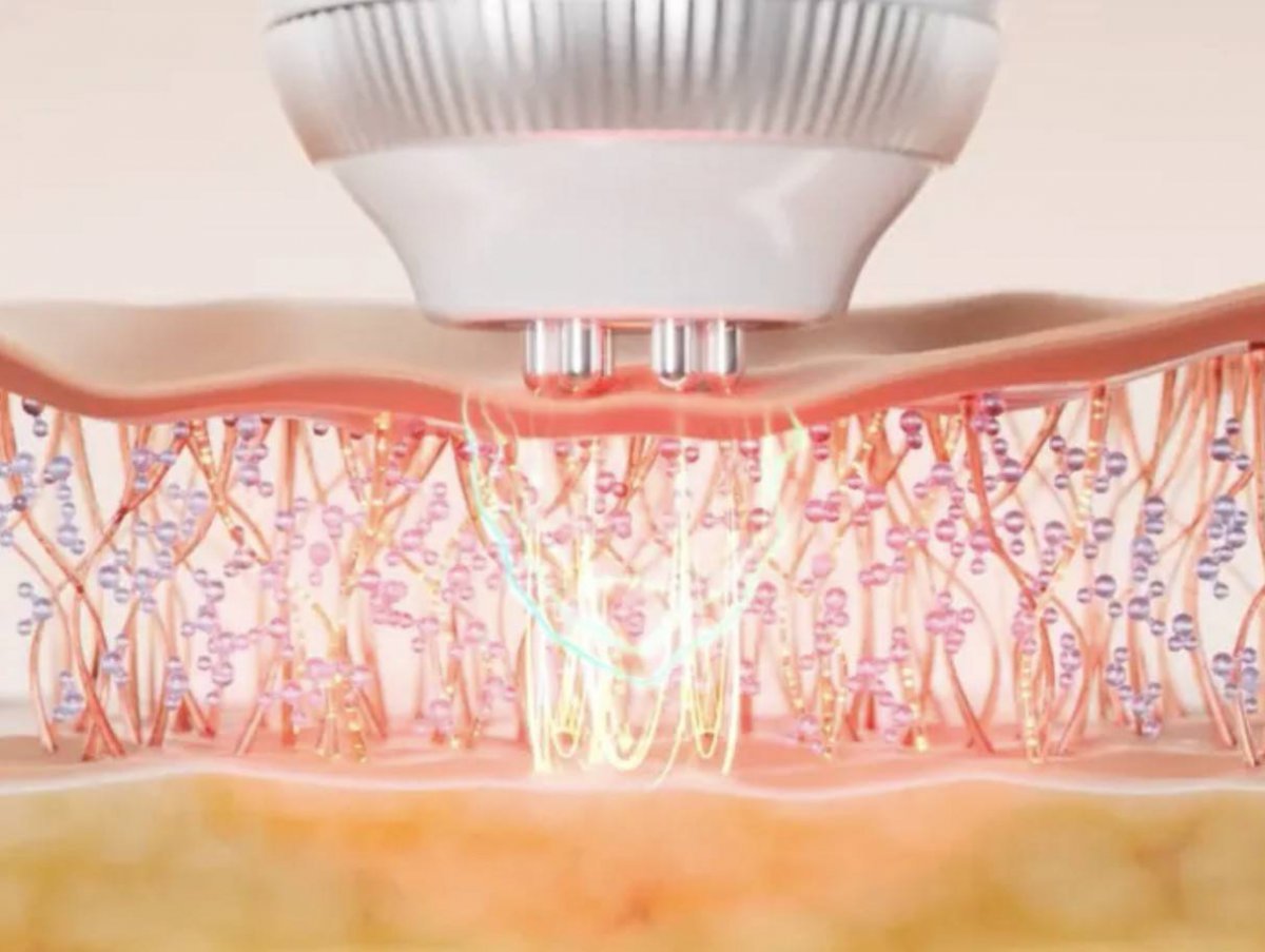 전극이 피부에 고주파와 미세 전류를 전달해 콜라겐 부스팅을 촉진한다. 사진은 이해를 돕기 위해 연출한 이미지 / 출처=에이피알