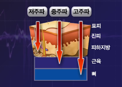 ■ 우리 몸속의 생체전기를 보완하는 전기 에너지 저주파는 1Hz∼1000Hz, 중주파는 1000Hz∼10만Hz, 고주파는 10만Hz 이상(0.1MHz)를 말한다.