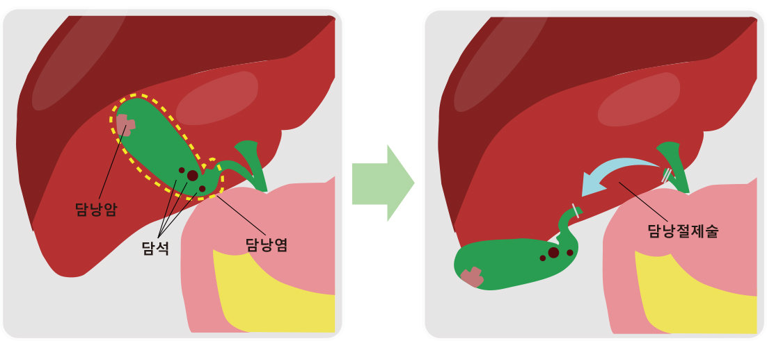 다양한 담낭질환과 담낭절제술의 모식도. 최근에는 개복수술보다 흉터가 남지 않고 출혈과 통증이 적으며 회복이 빠른 복강경 수술, 로봇수술 등이 시행되고 있다. 사진=순천향대 부천병원 제공