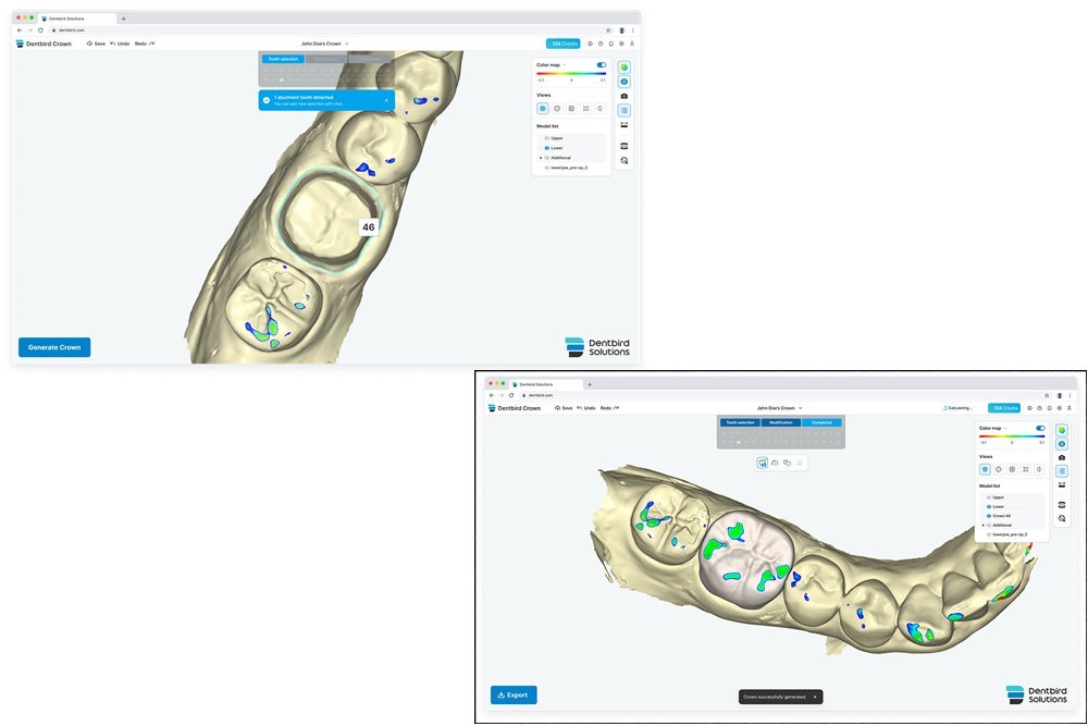 이마고웍스의 3D 치과 설계 소프트웨어 덴트버드 솔루션 (좌: 3D 치아 경계선 자동 검출, 우: 보철물 내면/외면 자동 3D  디자인) / 출처=이마고웍스