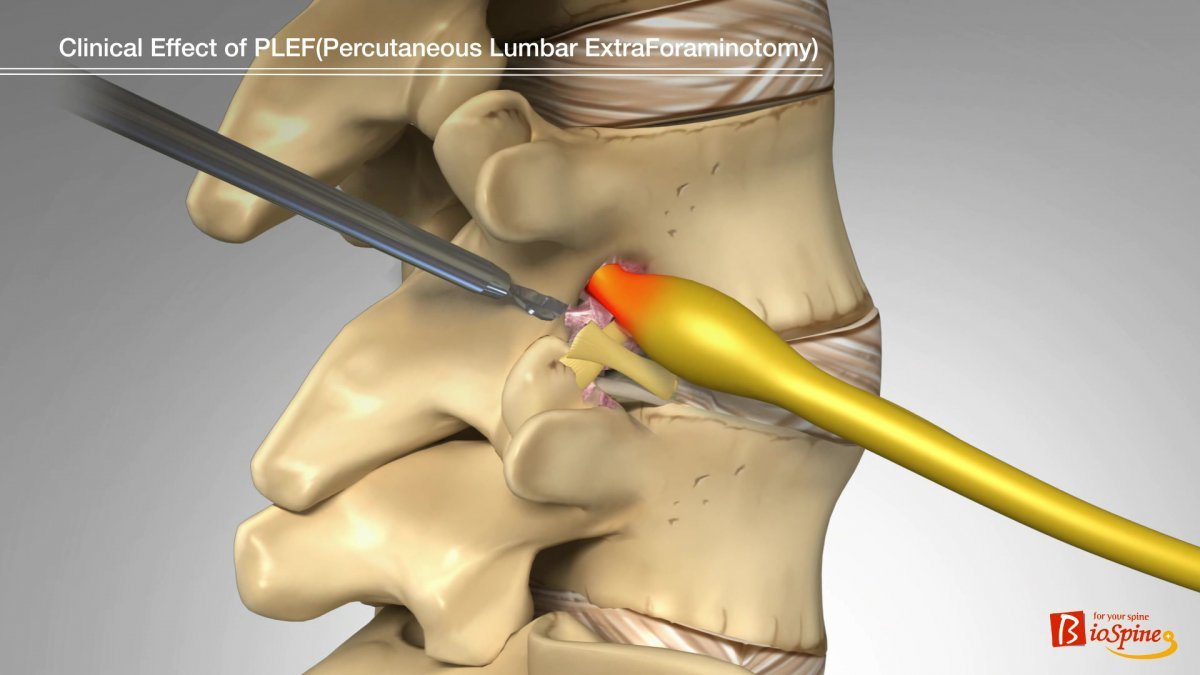 특수 키트로 인대를 절제해 신경의 물리적 압박을 해결하는 추간공확장술 기계적 치료 원리.