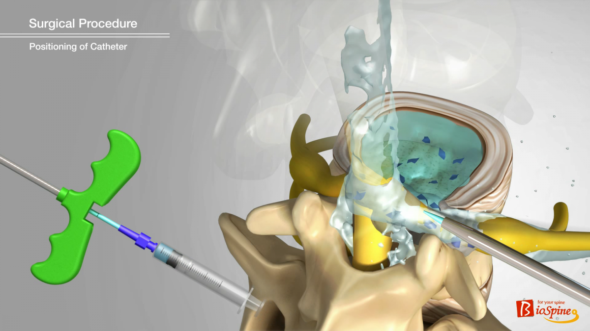 확보된 공간으로 염증 유발 물질과 유착을 씻어내는 추간공확장술 생화학적 치료 원리. 서울 광혜병원 제공