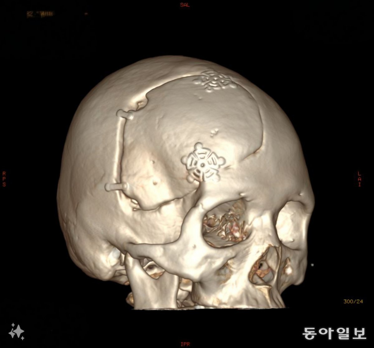 강경아씨의 3차원 뇌 사진. 광범위하게 뇌를 절제한 흔적이 보인다. 중앙대병원 제공