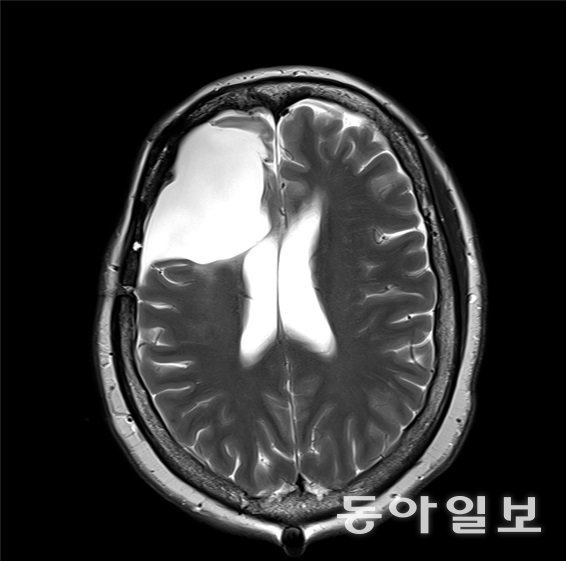 강경아 씨의 수술전(위쪽)과 수술후 뇌MRI 사진. 암덩어리가 완전히 제거됐음을 알 수 있다.