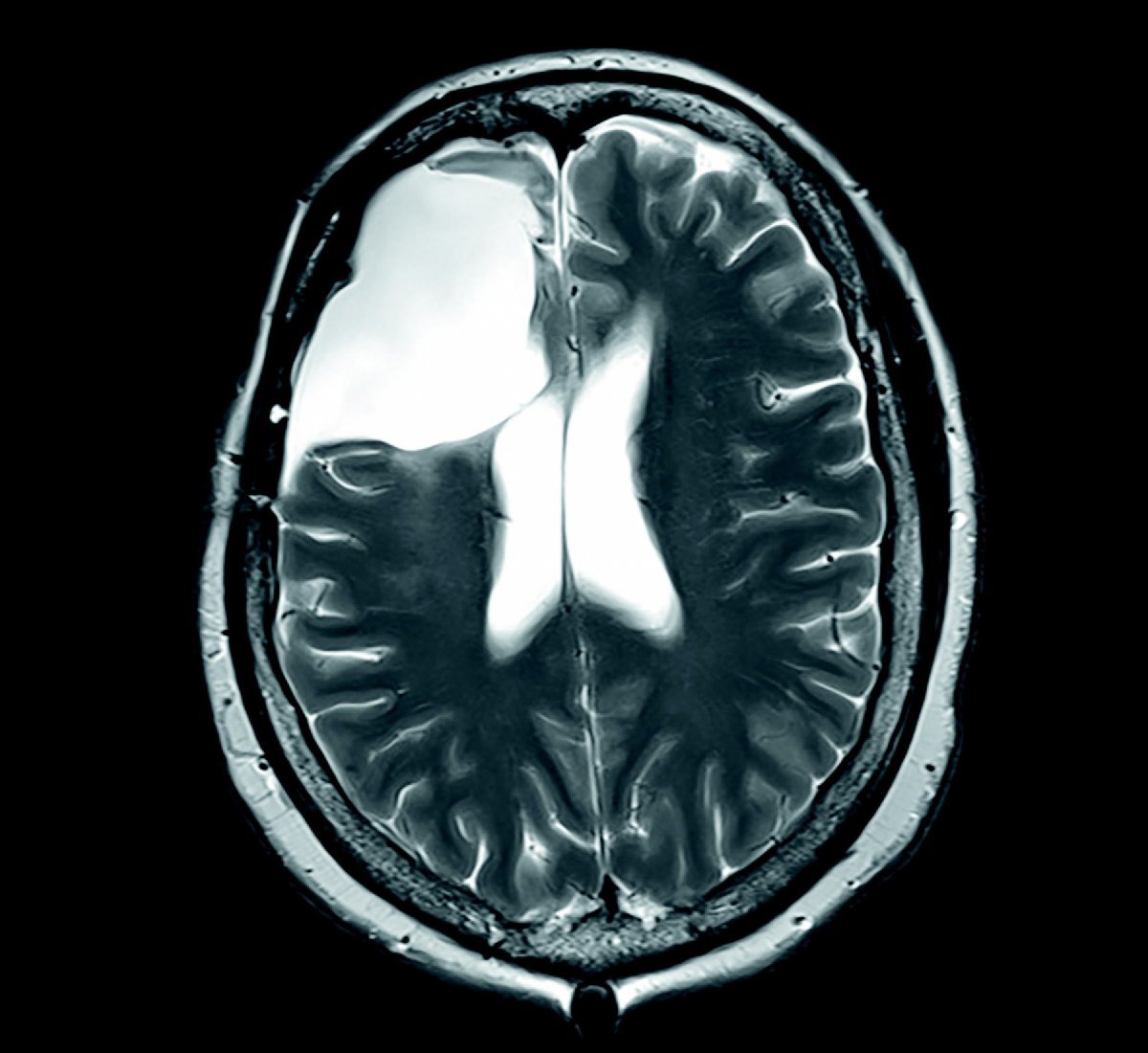 강경아 씨의 수술 전(위쪽)과 수술 후 뇌 MRI 사진. 지름이 6cm에 달하는 암덩어리가 완전히 제거된 모습이다. 중앙대병원 제공