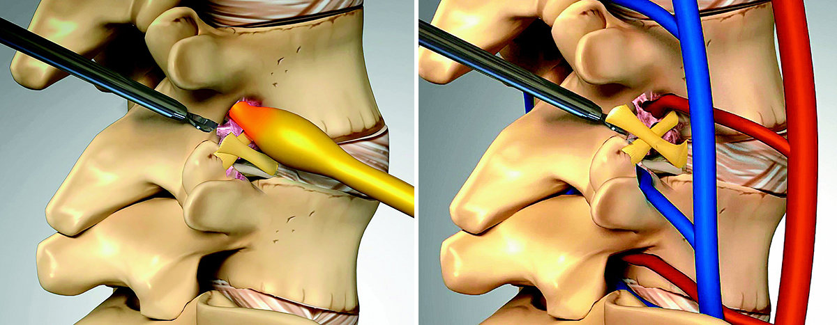 추간공의 내·외측 인대 절제로 추간공을 지나는 신경가지(왼쪽 사진)와 혈관의 압박을 줄여주는 추간공확장술 모식도. 서울 광혜병원 제공