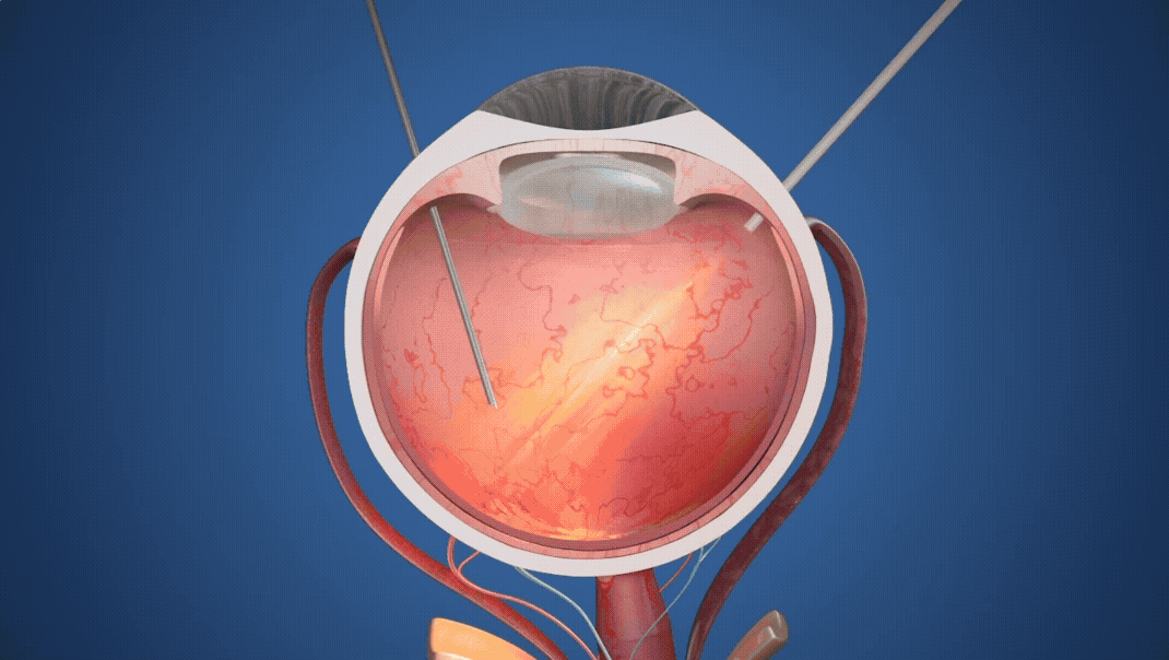 PRIMA 임플란트 작동 원리 시뮬레이션 영상. 망막 아래에 초소형 칩을 삽입하는 수술 과정과, 장치를 통해 환자가 시각 정보를 인식하는 과정. 사진=사이언스 코퍼레이션(Science Corporation) 공식 홈페이지