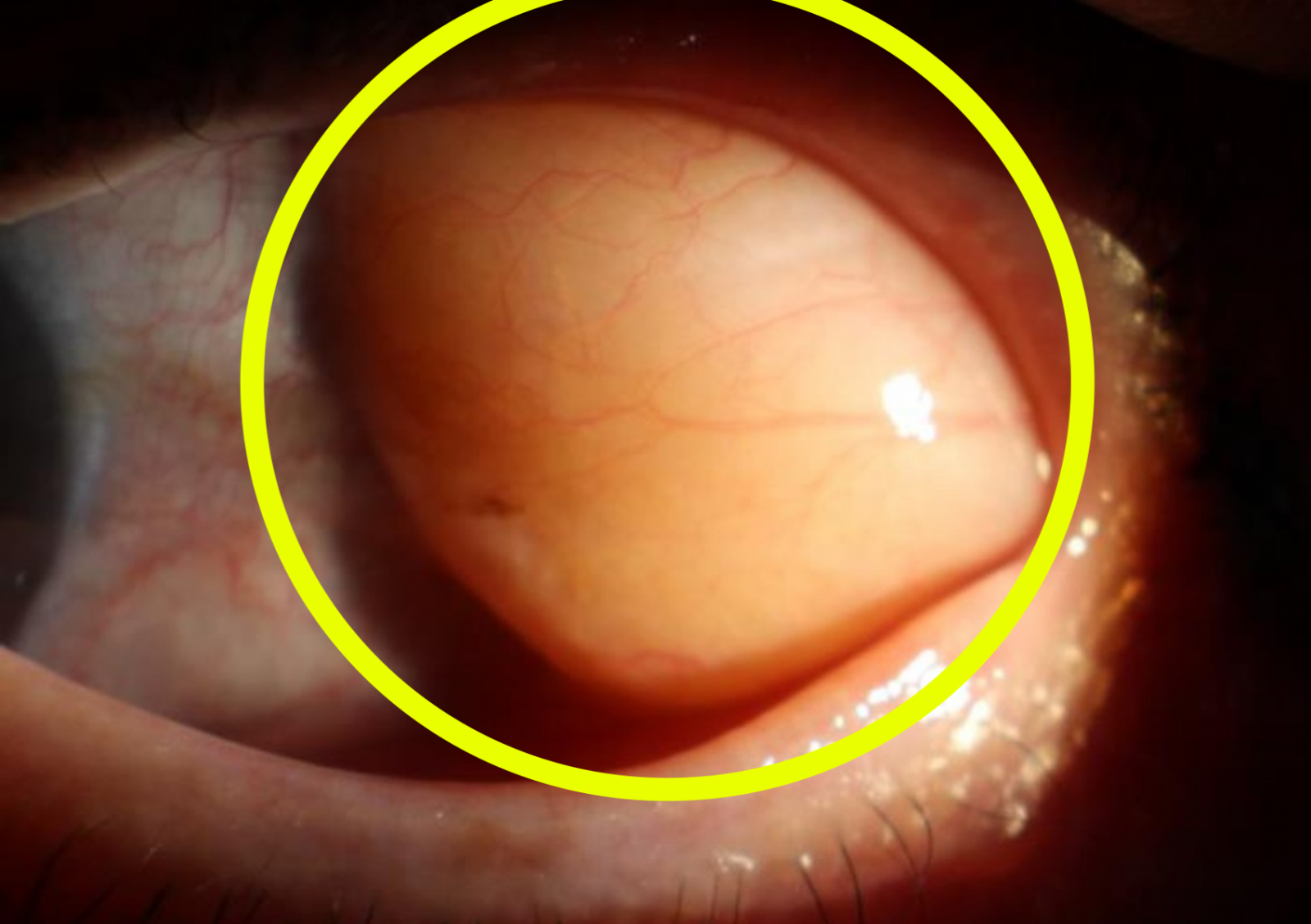 “눈 흰자 튀어나온 혹” 그냥 둬도 괜찮을까?
