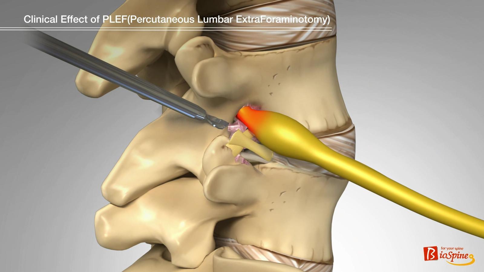 추간공확장술 사진. 추간공확장술을 통해 특수 키트로 인대를 절제하고 좁아진 공간을 넓혀주는 모습. 광혜병원 제공