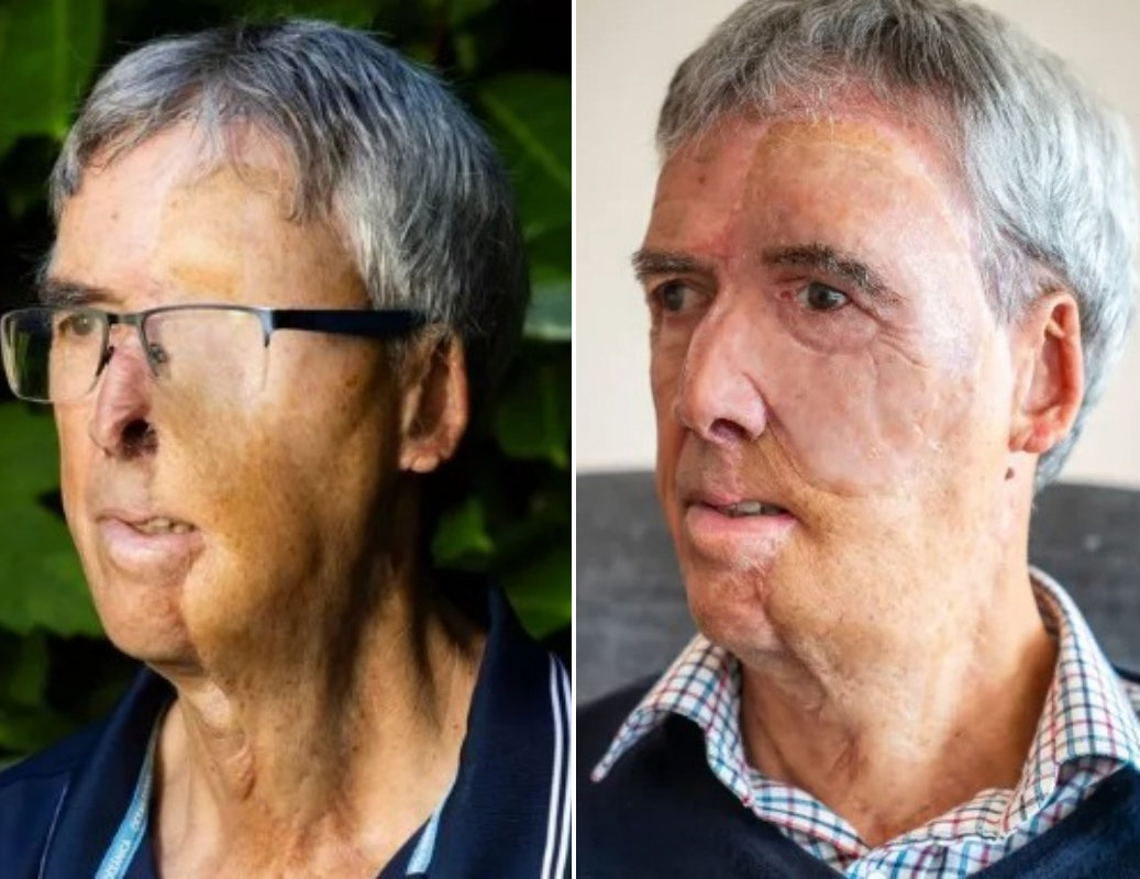 3D 프린팅 기술로 제작된 맞춤형 안면 보형물을 착용한 데이브 리차즈가 새 얼굴로 자신감을 되찾았다. 레딧 갈무리