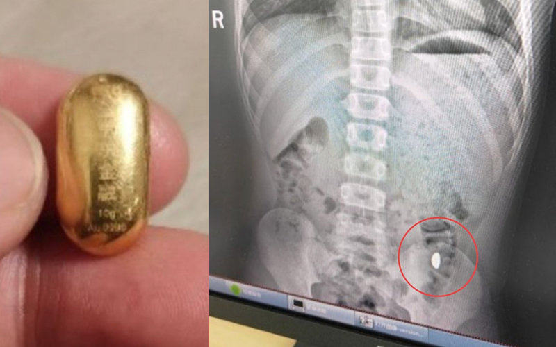 중국인 지모 씨가 공개한 아들 뱃속에 있던 200만 원 상당의 금콩. X캡처