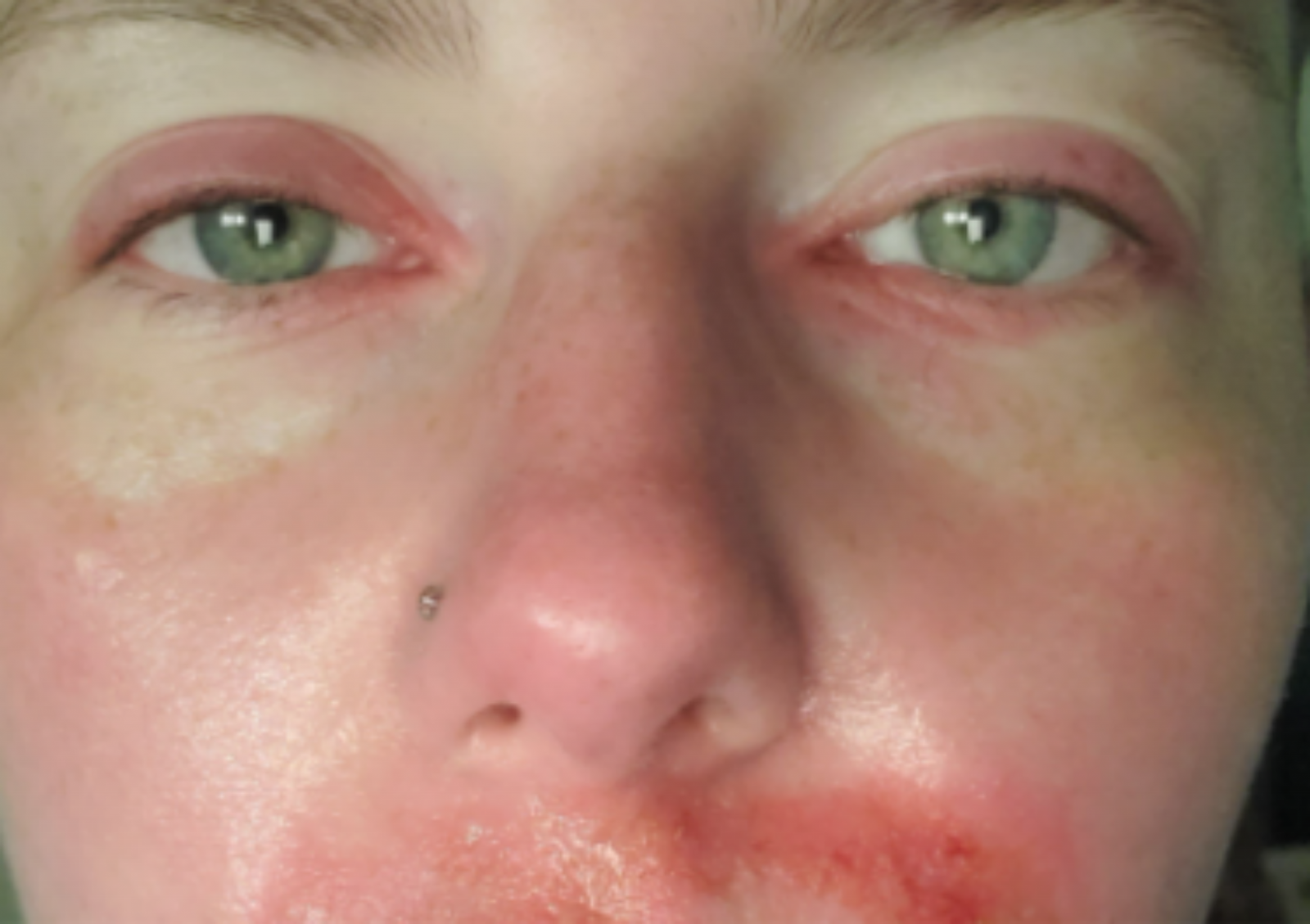 햇빛에 단 30초만 노출돼도 3도 화상을 입는 여성의 사연이 전해졌다. 희귀 질환 ‘햇빛 알레르기’로 고통받는 그는 스스로를 “뱀파이어처럼 살아간다”고 표현했다. 사진=gofundme 홈페이지 캡쳐