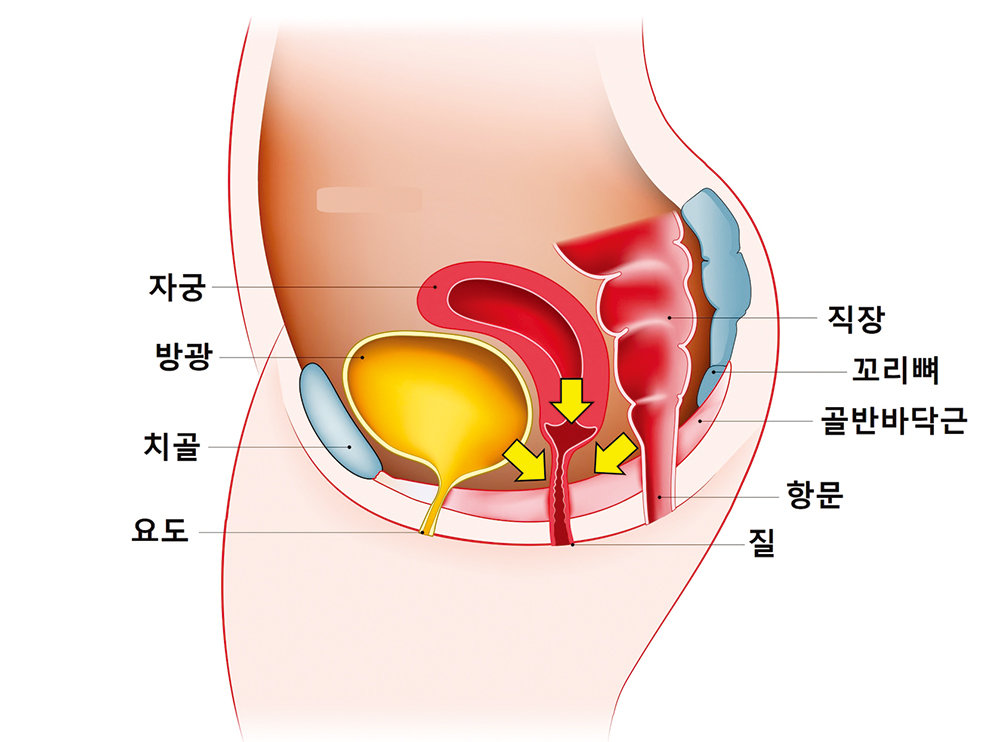 골반장기탈출증 개념도. 고려대학교의료원 제공
