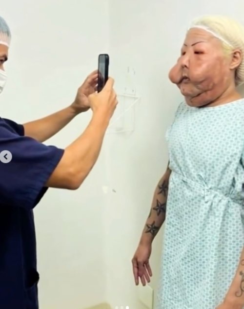 불법 시술로 변형된 얼굴을 재건 수술 받기 위해 준비 중인 줄리아나 올리베이라. 출처=‘인콰이어러’