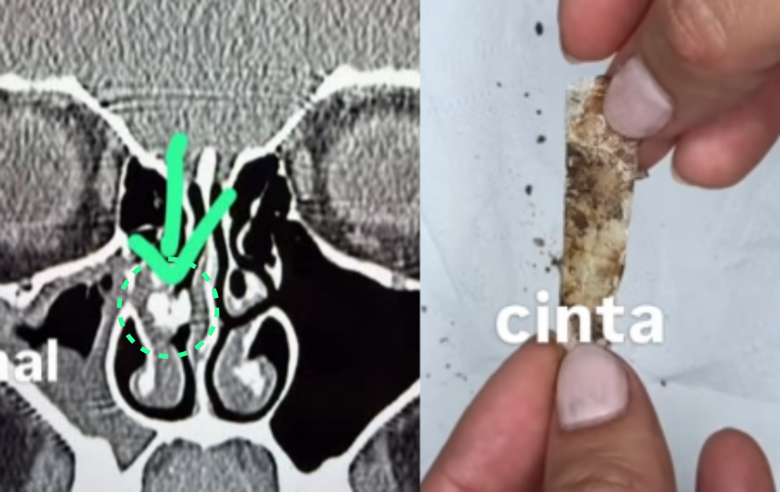 아르헨티나의 35세 여성의 코 속에서 약 8x6㎜ 크기의 접착 테이프 뭉치가 발견됐으며, 이 이물질은 신생아 때 의료 과정에서 잔류한 것으로 추정됐다. 테이프 제거 후 이 여성은 35년 만에 양쪽 코로 정상적인 호흡을 할 수 있게 됐다고 전했다. 사진=인스타그램 @candelanutri