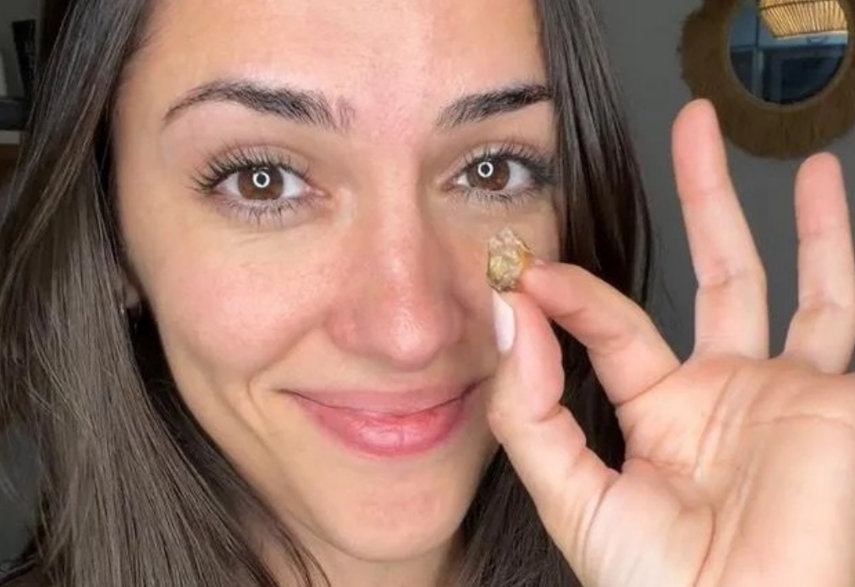 아르헨티나의 35세 여성의 코 속에서 약 8x6㎜ 크기의 접착 테이프 뭉치가 발견됐으며, 이 이물질은 신생아 때 의료 과정에서 잔류한 것으로 추정됐다. 테이프 제거 후 이 여성은 35년 만에 양쪽 코로 정상적인 호흡을 할 수 있게 됐다고 전했다. 사진=인스타그램 @candelanutri