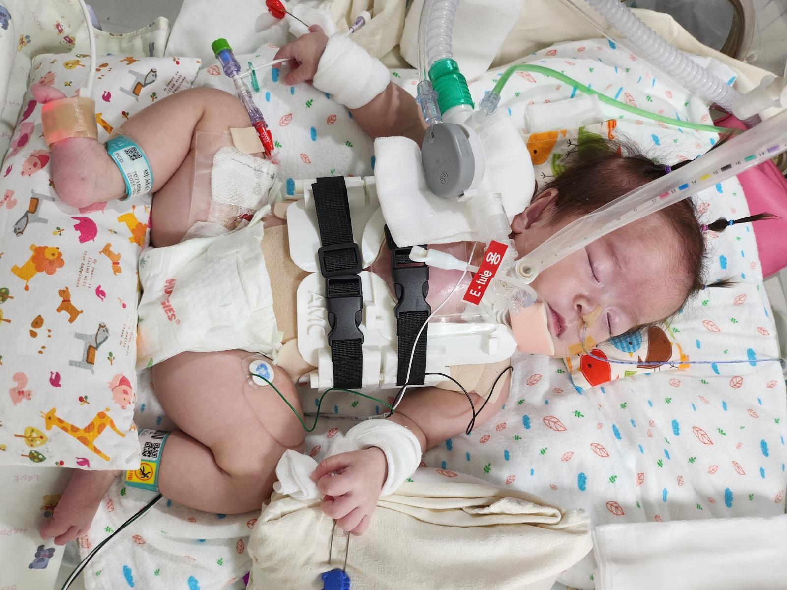 9월 3일 양측 흉곽을 모아주기 위해 3D 프린팅으로 제작한 맞춤형 흉부 보호대를 착용하고 있는 서린이의 모습.(서울아산병원 제공)