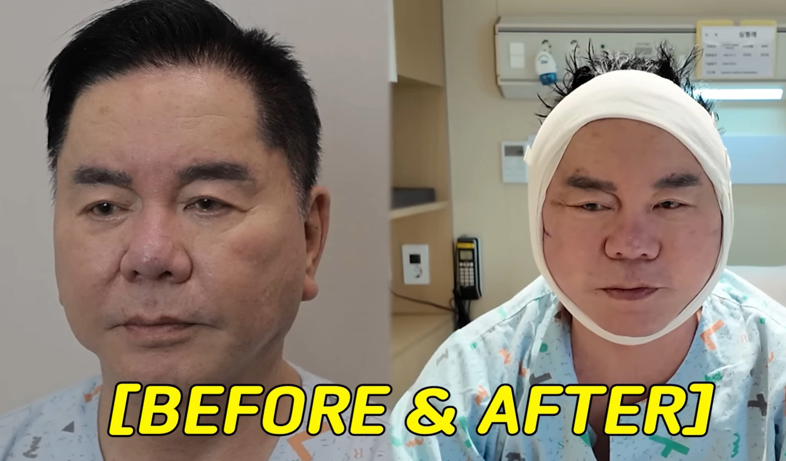 안면거상술 받은 심형래. 유튜브 캡처