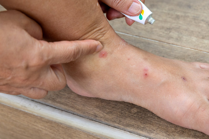 미국 버지니아주 한 가족이 미국에서 유럽으로 향하던 국제선 항공편에서 기내 빈대 피해를 입었다며 델타항공과 KLM 네덜란드 항공을 상대로 손해배상 소송을 제기했다. 게티이미지뱅크