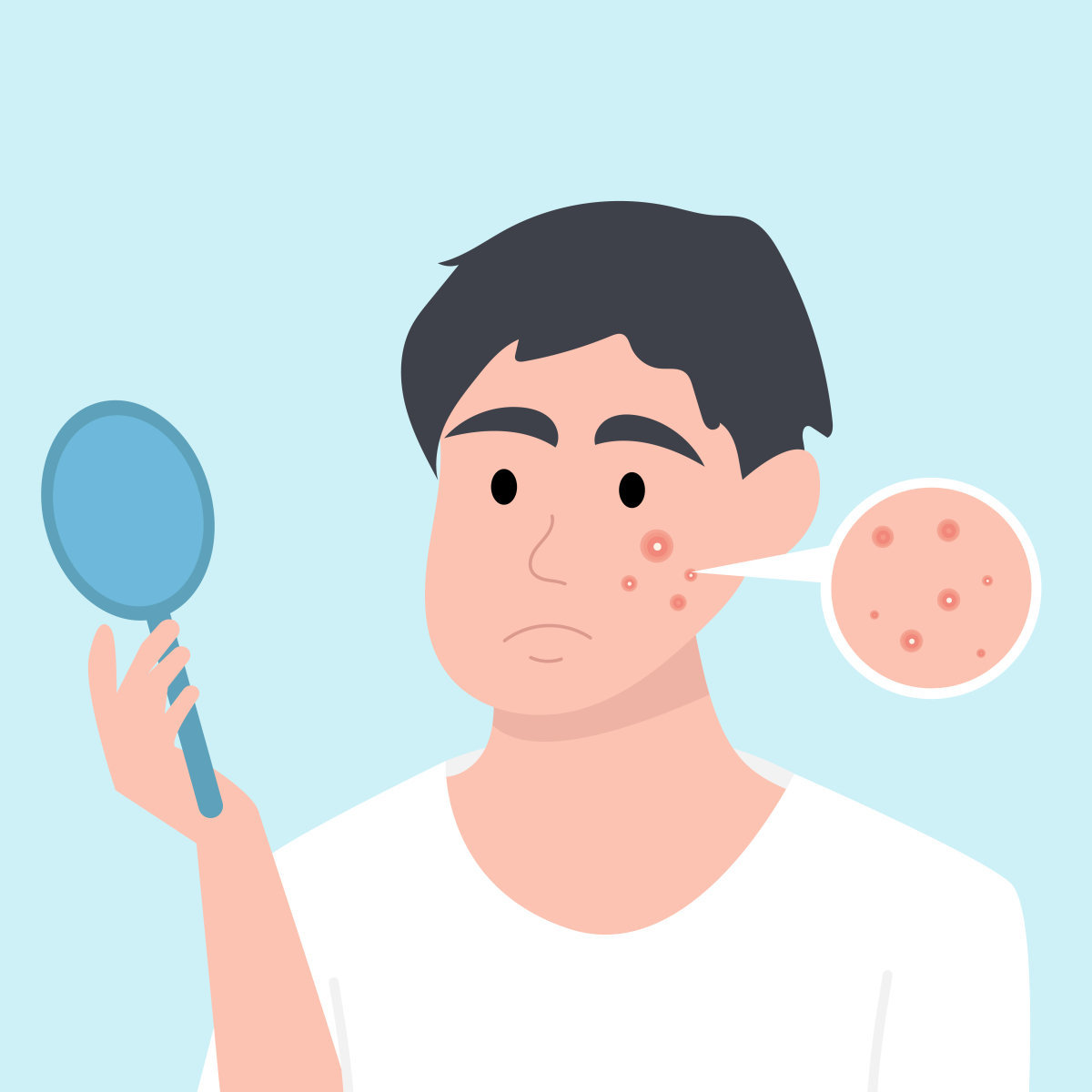 여드름이 나는 원인 가운데 혐기성 세균(여드름균)이나 두꺼운 각질층과 관련된 것은 생활 습관 개선으로 해결될 여지가 있다. GETTYIMGAES