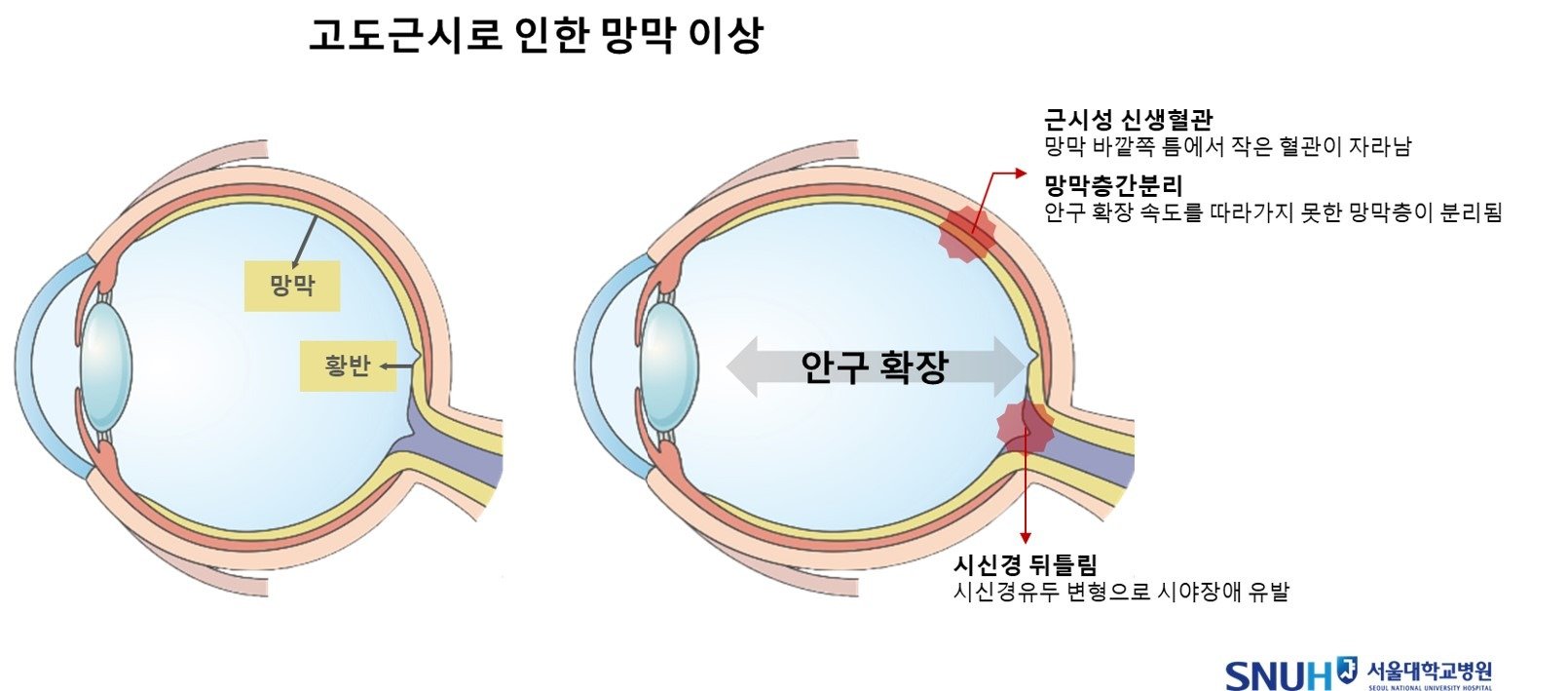 고도 근시로 인한 망막 이상.(서울대병원 제공)