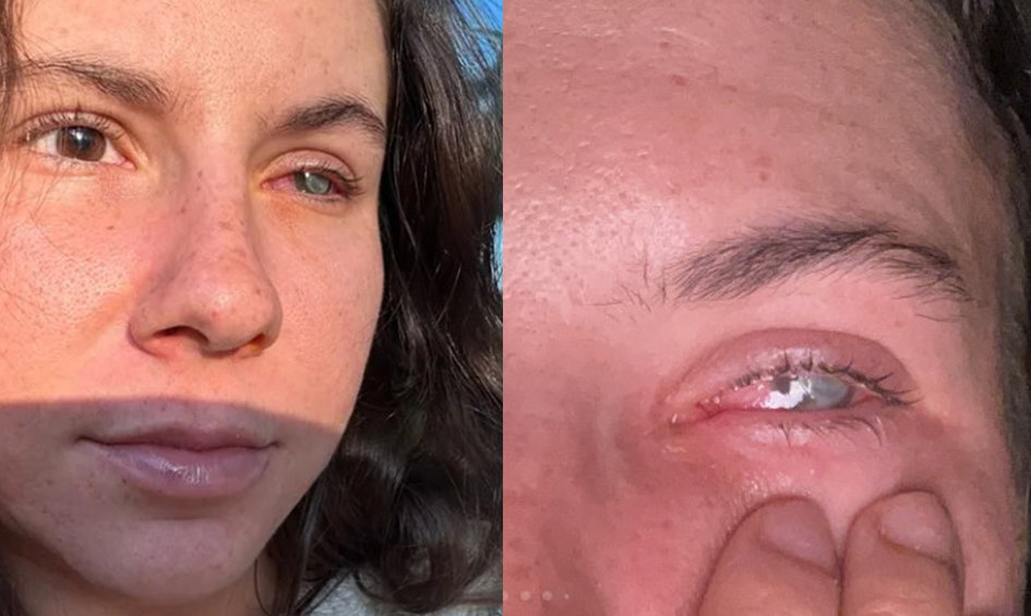 멕시코 여행 중 기생충 감염으로 오른쪽 눈 시력을 잃은 비비안 노소비츠키의 모습. 치료비 마련을 위해 개설한 고펀드미(GoFundMe) 페이지에 공개된 사진. gofundme