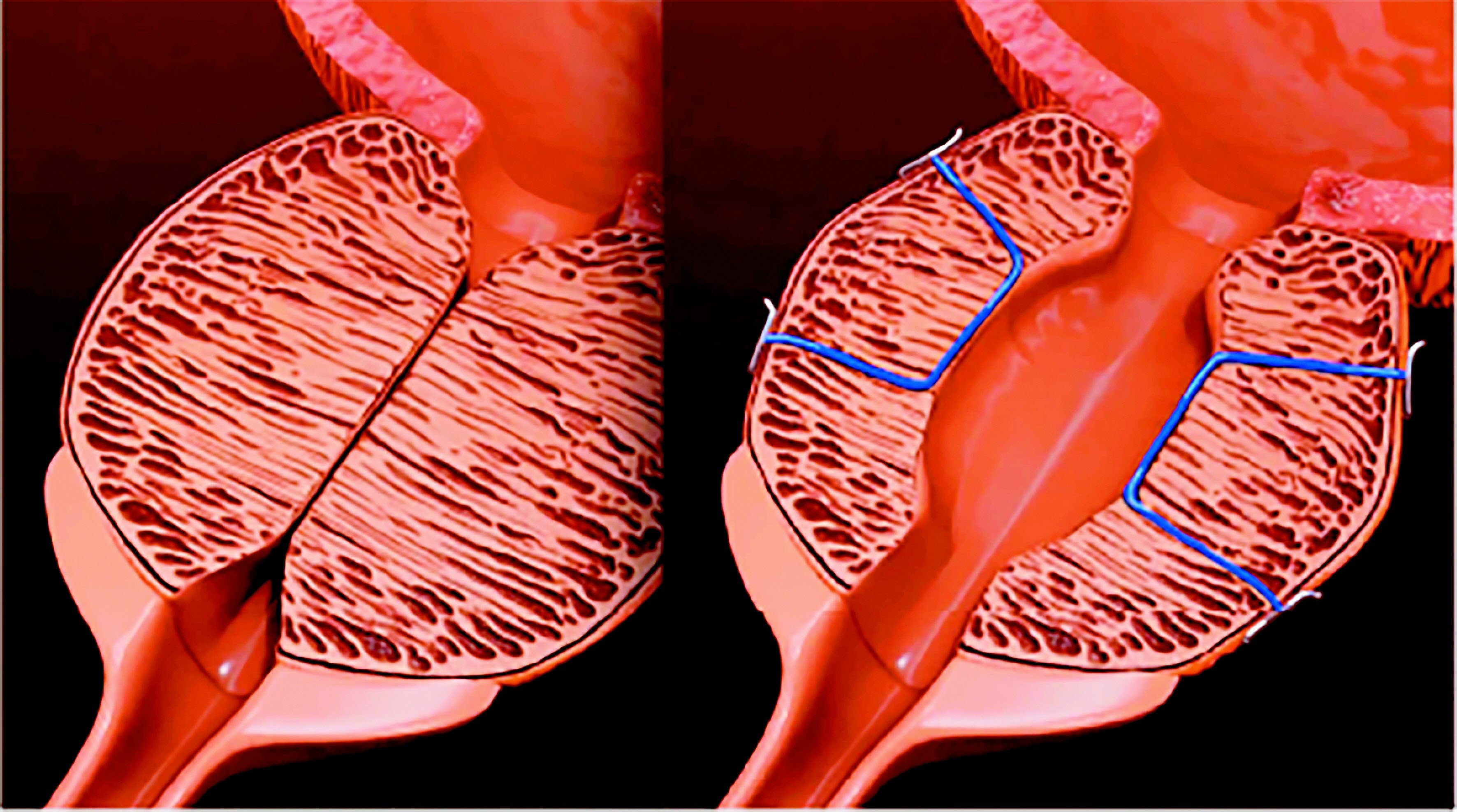 새로운 방식의 전립선 결찰술 ‘프로게이터’의 결찰 방식.