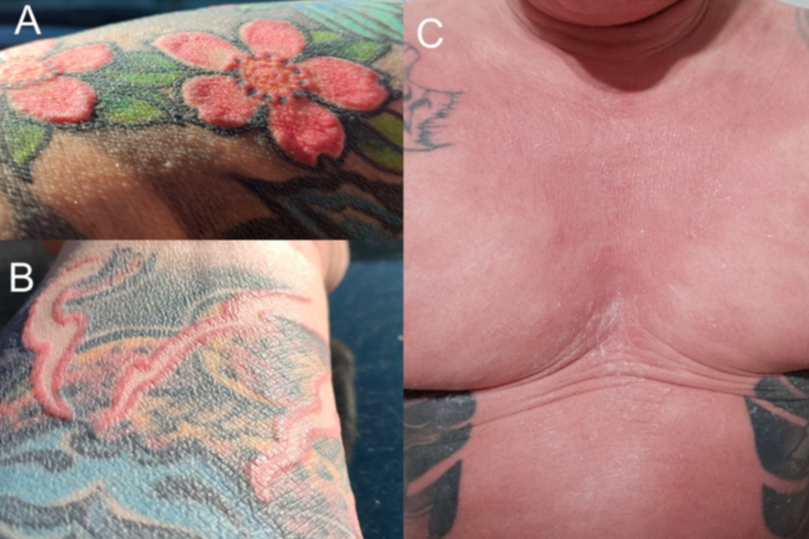 36세 남성이 붉은색 문신 시술 후 전신 홍피증, 탈모, 백반증 및 땀샘 파괴에 따른 무한증 등 심각한 전신 부작용을 겪었다. 사진=Clinics and Practice