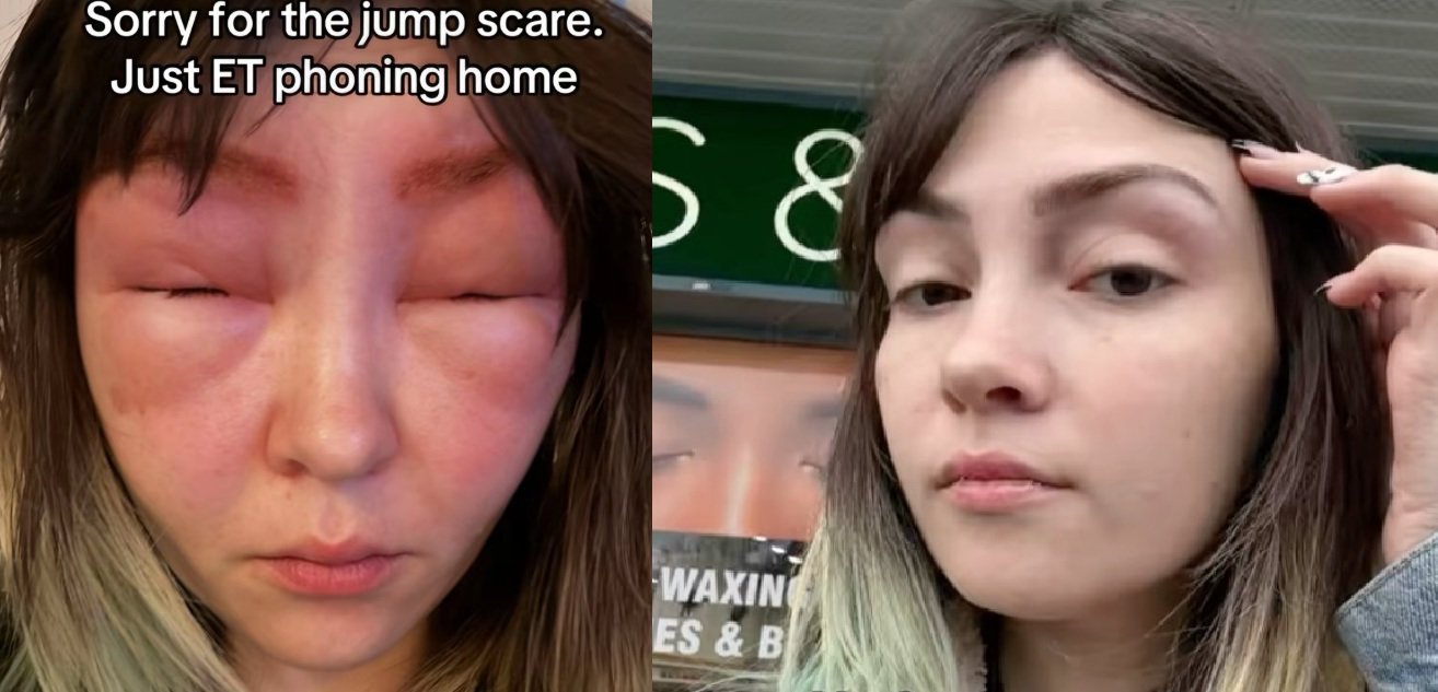 “눈썹 염색하다 ‘외계인’ 됐다”…알레르기 테스트의 중요성