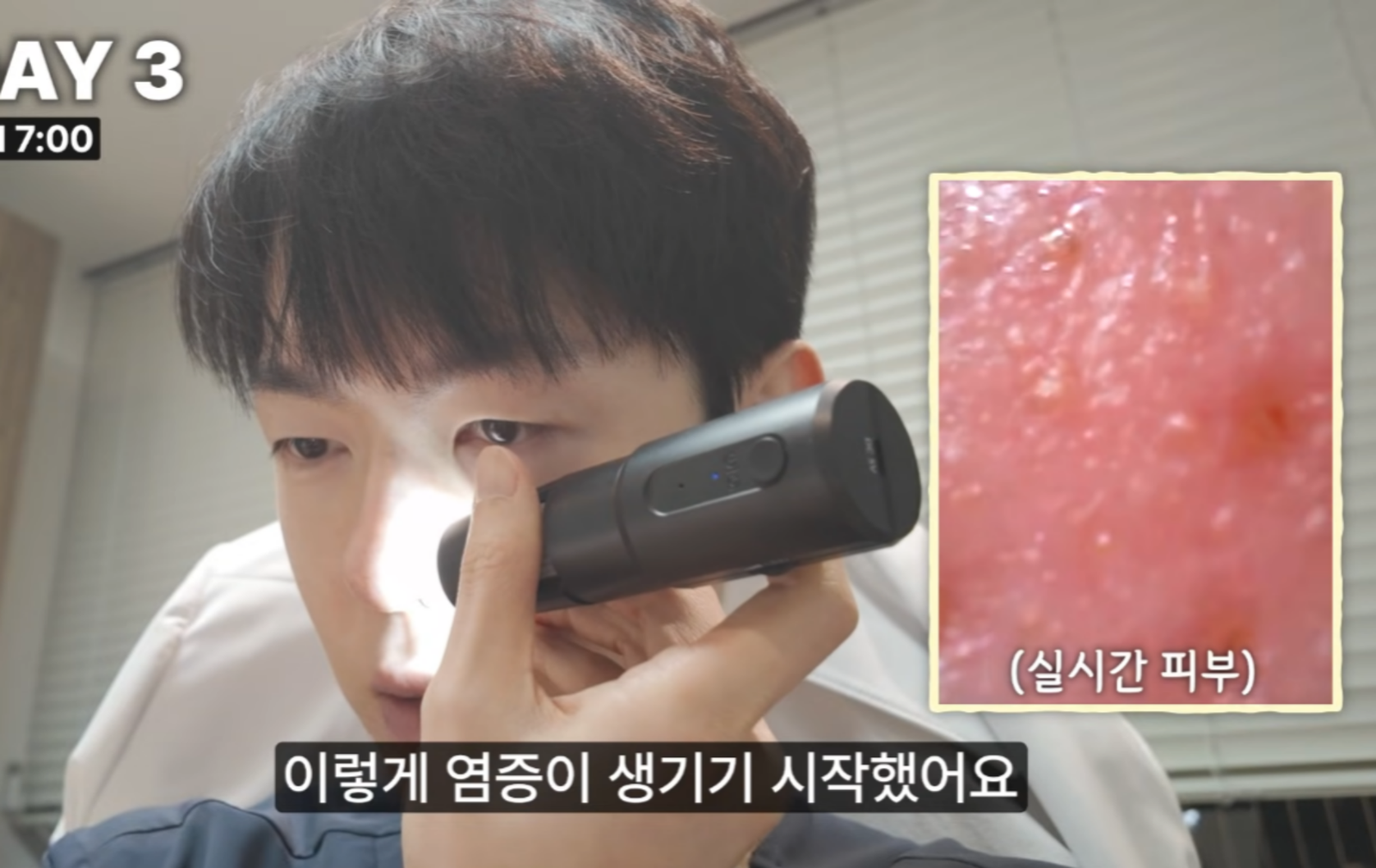 피부과 전문의가 일주일간 고당·고지방 식단을 섭취한 결과 피부 나이가 31세에서 36세로 급격히 노화됐다. 사진=유튜브 ‘피친남 이승주’ 캡쳐