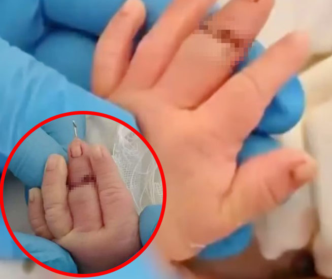 탯줄 자르다가 아기 손가락 절단…中간호사 황당 실수