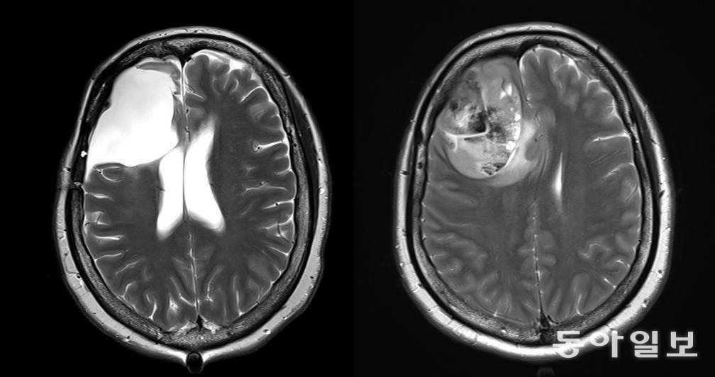 뇌종양(교모세포종)을 앓는 환자의 뇌 MRI 사진(왼쪽)과 뇌종양(교모세포증) 환자의 종양을 제거한 후 뇌 MRI 사진(오른쪽). 동아일보 DB